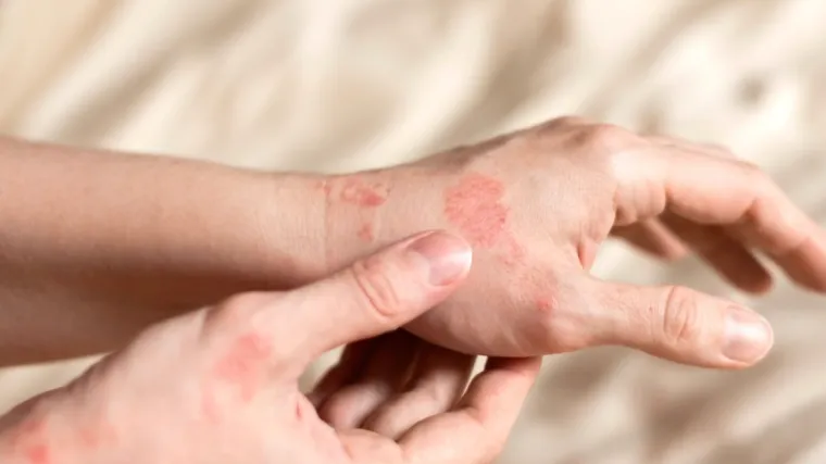 Otkrili ste jeste li iznenađeni pojavom svraba, pogledajte odgovore