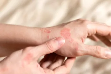 Otkrili ste jeste li iznenađeni pojavom svraba, pogledajte odgovore