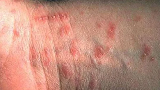 U jednoj županiji pojavila se zarazna bolest, među oboljelima i dijete, a nisu međusobno povezani