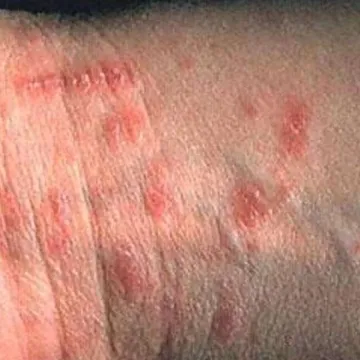 U jednoj županiji pojavila se zarazna bolest, među oboljelima i dijete, a nisu međusobno povezani