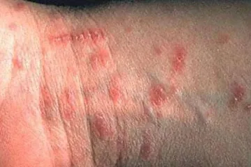 U jednoj županiji pojavila se zarazna bolest, među oboljelima i dijete, a nisu međusobno povezani