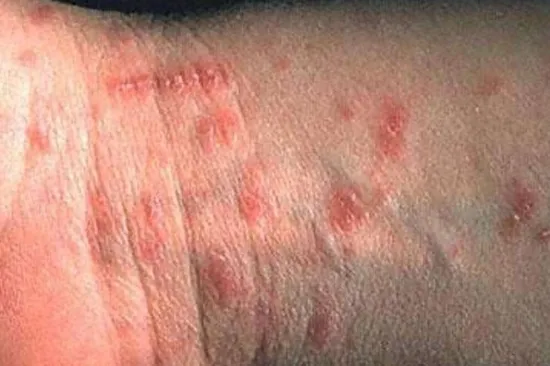 Zarazna bolest u hrvatskoj županiji: Među oboljelima i dijete, a nisu međusobno povezani