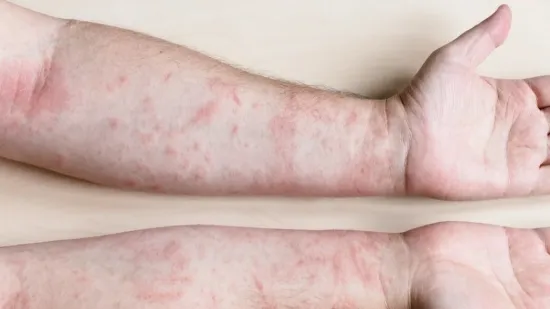 &Scaron;ugom se zarazilo dvoje odraslih ljudi, a onda i jedno dijete - nisu povezani