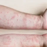 &Scaron;ugom se zarazilo dvoje odraslih ljudi, a onda i jedno dijete - nisu povezani