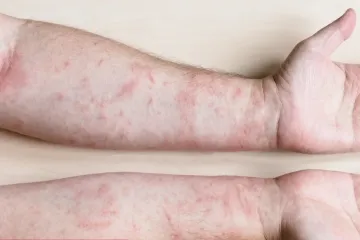 &Scaron;ugom se zarazilo dvoje odraslih ljudi, a onda i jedno dijete - nisu povezani