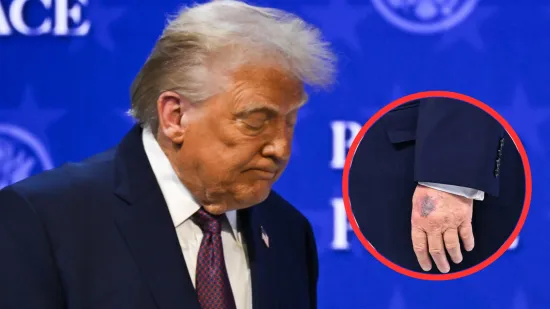 Trump opet snimljen s modricom i to na drugoj ruci: 'Uzimam veću dozu, želim rijetku krv'