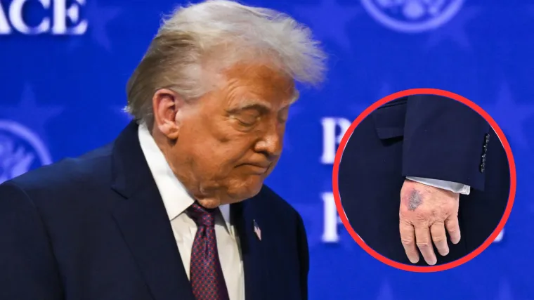 Trump opet snimljen s modricom i to na drugoj ruci: 'Uzimam veću dozu, želim rijetku krv'