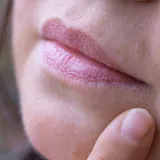 Ova pojava na licu prvi je znak starenja: Dermatolozi otkrivaju kako zadržati mladolik izgled