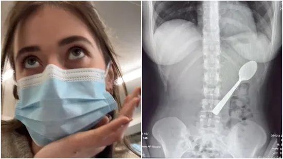 Žlica duga 17 centimetara zavr&scaron;ila je u želucu mlade žene: Cijeli slučaj je ba&scaron; bizaran