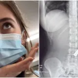 Žlica duga 17 centimetara zavr&scaron;ila je u želucu mlade žene: Cijeli slučaj je ba&scaron; bizaran