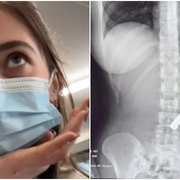 Žlica duga 17 centimetara zavr&scaron;ila je u želucu mlade žene: Cijeli slučaj je ba&scaron; bizaran