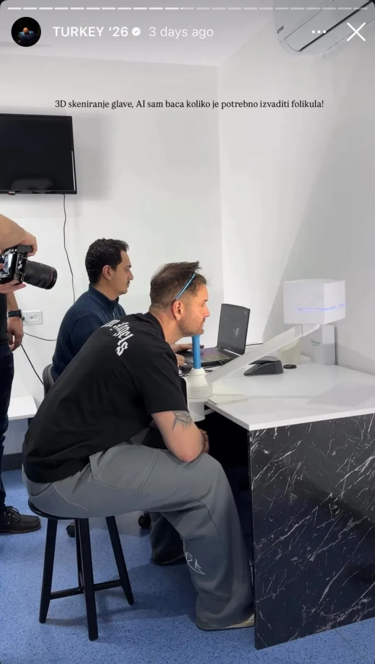 Sandi Pego oti&scaron;ao na transplantaciju kose u Tursku pa pokazao kako je to izgledalo