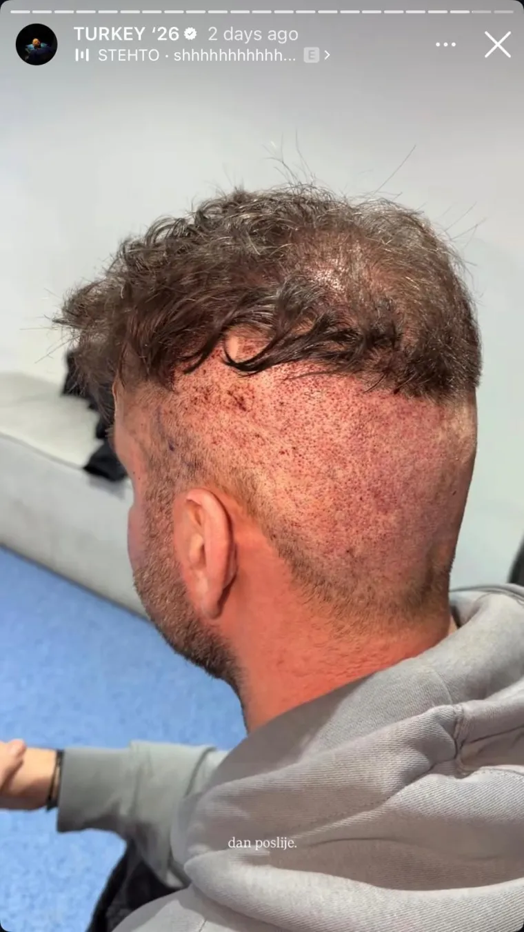 Sandi Pego oti&scaron;ao na transplantaciju kose u Tursku pa pokazao kako je to izgledalo