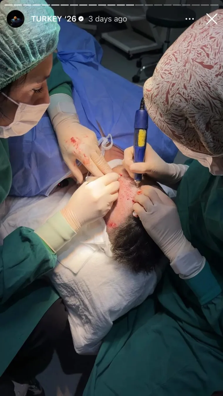 Sandi Pego oti&scaron;ao na transplantaciju kose u Tursku pa pokazao kako je to izgledalo