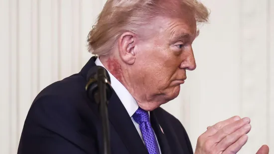 &Scaron;to je to na vratu Donalda Trumpa? 'Predsjednik koristi tretman'