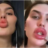 Godinama je punila obraze filerima, a sada je odlučila vratiti prirodno lice: Promjena je ogromna