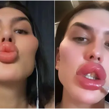 Godinama je punila obraze filerima, a sada je odlučila vratiti prirodno lice: Promjena je ogromna