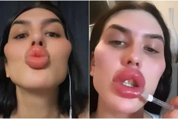 Godinama je punila obraze filerima, a sada je odlučila vratiti prirodno lice: Promjena je ogromna