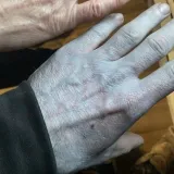 Probudio se plav poput &scaron;trumpfa, cijela bolnica i u ovom trenutku priča o njegovu slučaju