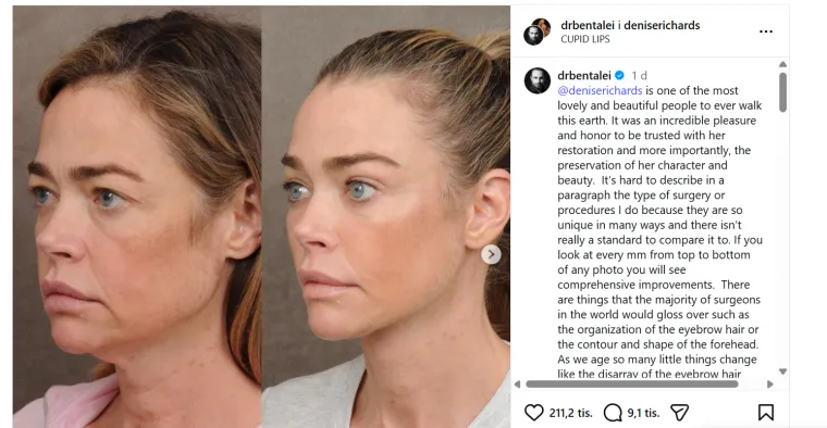 &Scaron;okantna transformacija Denise Richards: Glumica pokazala rezultate faceliftinga