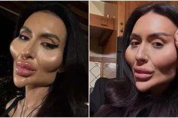 Ponosno nosi titulu žene s najvećim obrazima: Prije je bila prava ljepotica, evo kako je izgledala