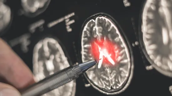 Ove skrivene moždane stanice pomažu rastu smrtonosnog raka: 'Lijek možda postoji'