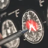 Ove skrivene moždane stanice pomažu rastu smrtonosnog raka: 'Lijek možda postoji'