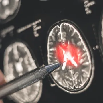 Ove skrivene moždane stanice pomažu rastu smrtonosnog raka: 'Lijek možda postoji'