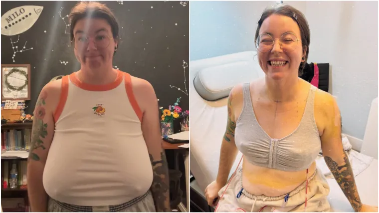 Godinama je patila zbog golemih grudi: 'Na kraju sam nosila vi&scaron;e grudnjaka odjednom'