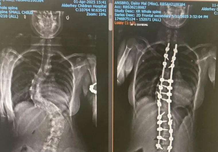 Preživjela je moždani udar i &scaron;est operacija srca i kralježnice: 'Ponosna sam na svoje ožiljke'