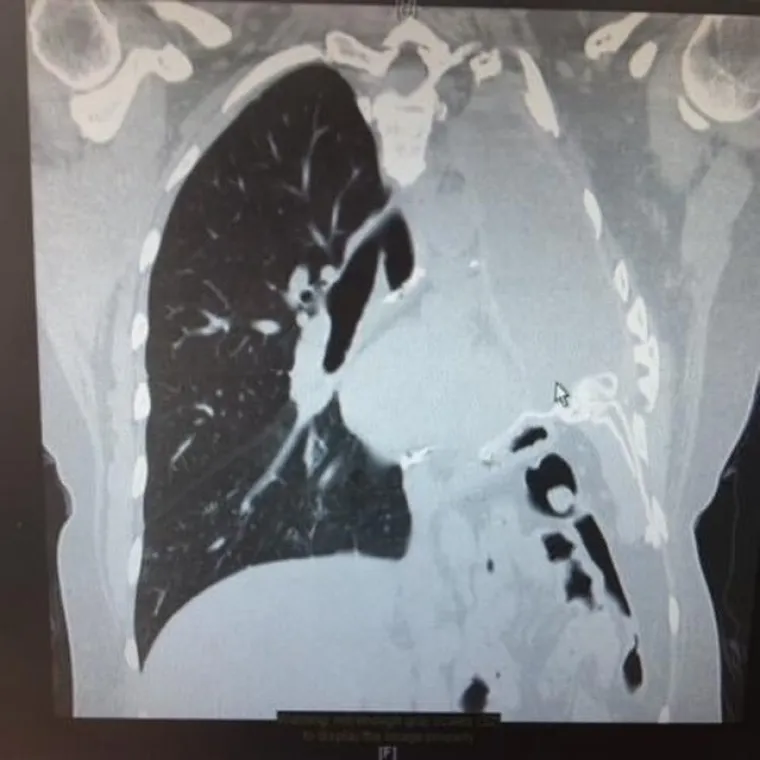 Davali su joj 15 mjeseci života: Dijagnosticirali joj rak zbog očevog komada odjeće