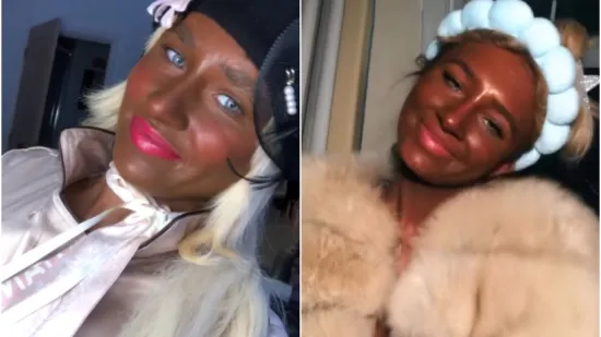 Ovisna je o solariju do te mjere da si je unakazila kožu, a ba&scaron; je bila slatka djevojka