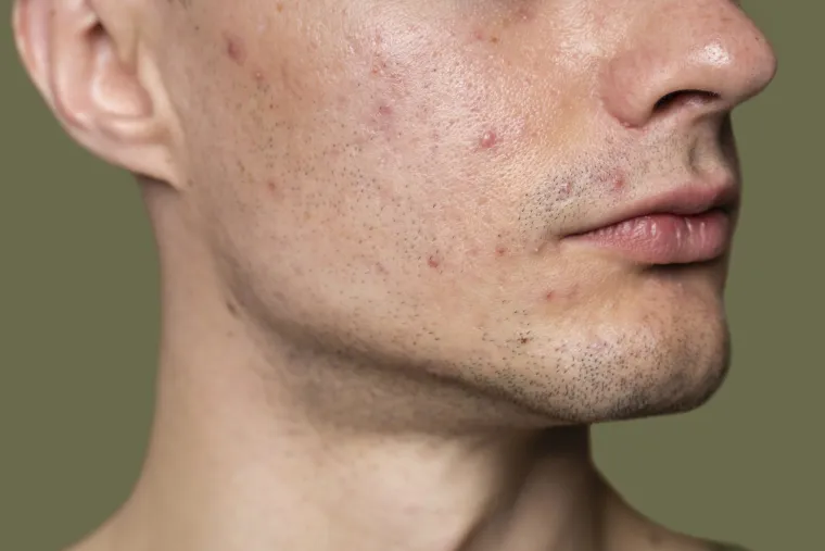 Mjesto na kojem se javljaju pri&scaron;tići otkriva kakvo vam je zdravlje? 'Nije univerzalno pravilo'