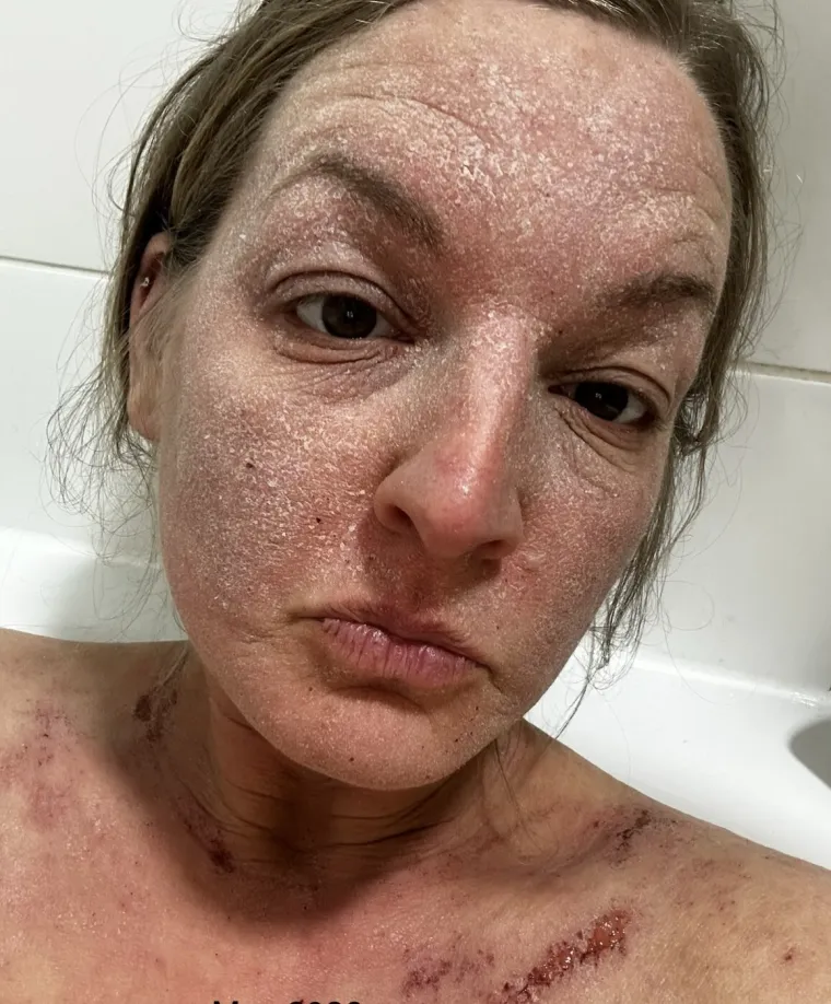 Liječila je kožu kremama za ekcem i proživjela pakao: 'Tako sam umorna i sve me boli'