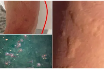 Popodnevno kupanje kraj Splita pretvorio se u bolnu agoniju: 'Peklo nas je cijelo tijelo'