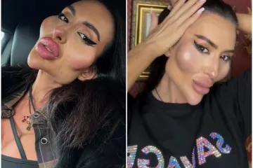 Žena s najvećim obrazima u dugotrajnom je procesu otapanja filera: Promjene su već vidljive