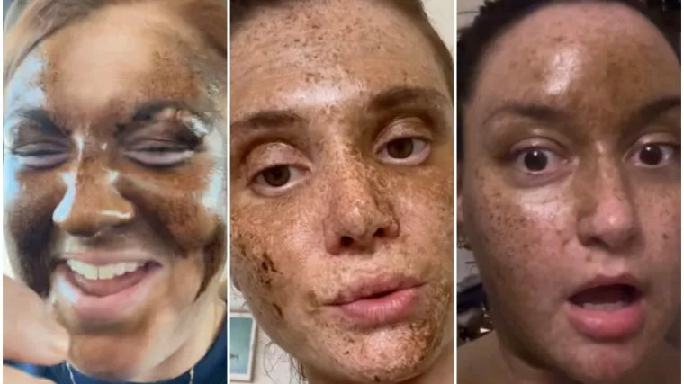 Htjele su brončani ten, a dobile lice iz noćne more: Sprej za samotamnjenje ih je ba&scaron; unakazio