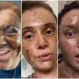 Htjele su brončani ten, a dobile lice iz noćne more: Sprej za samotamnjenje ih je ba&scaron; unakazio