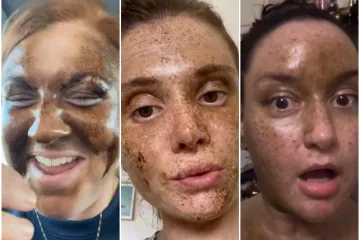 Htjele su brončani ten, a dobile lice iz noćne more: Sprej za samotamnjenje ih je ba&scaron; unakazio