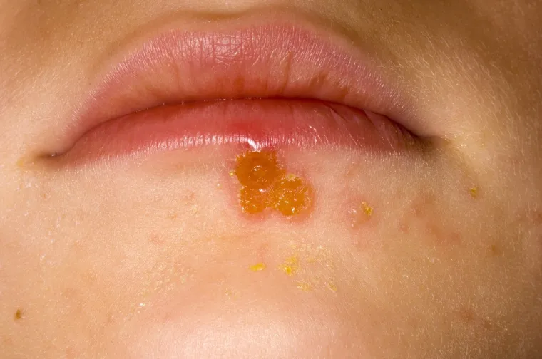 &Scaron;iri se zaraza u hrvatskom gradu, ambulante pune djece: Evo kako je prepoznati i liječiti