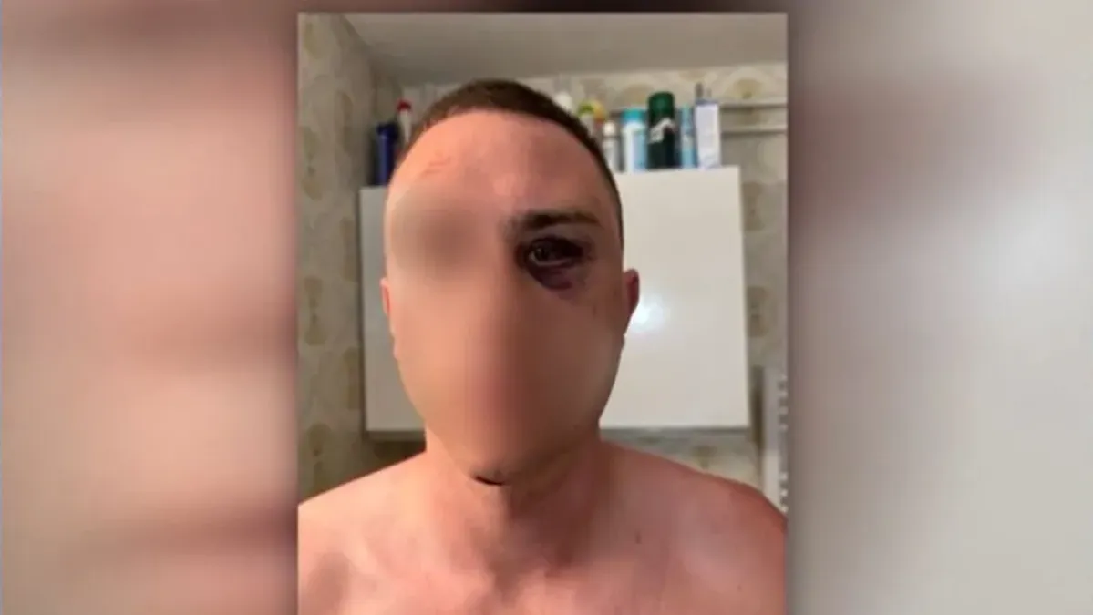 Progovorio pretučeni Slovenac u Medulinu: 'Nakon &scaron;to sam pao, drugi me je udario'