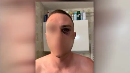 Progovorio pretučeni Slovenac u Medulinu: 'Nakon &scaron;to sam pao, drugi me je udario'