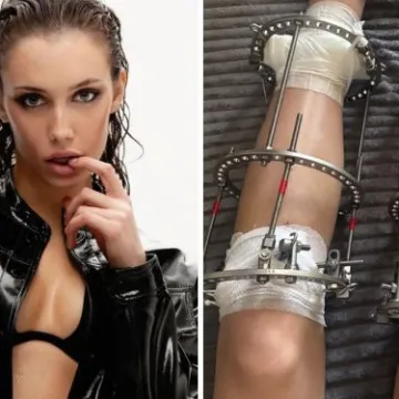 &Scaron;okantna odluka modela: Dobrovoljno dala slomiti noge zbog karijere