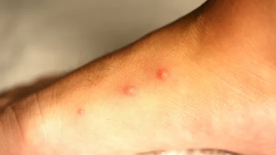 Liječnici savjetuju kako reagirati kod ugriza i uboda kukaca: 'Nekad je potrebna hitna pomoć'