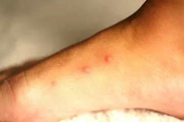 Liječnici savjetuju kako reagirati kod ugriza i uboda kukaca: 'Nekad je potrebna hitna pomoć'