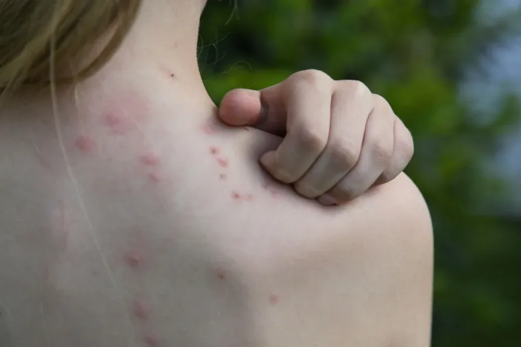 Liječnici savjetuju kako reagirati kod ugriza i uboda kukaca: 'Nekad je potrebna hitna pomoć'