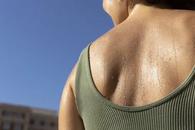 Vrućine utječu na ovu kožnu bolest: Dermatolozi objasnili za&scaron;to se simptomi pogor&scaron;avaju