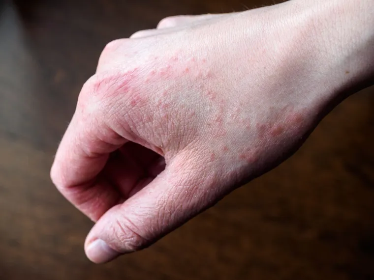 Vrućine utječu na ovu kožnu bolest: Dermatolozi objasnili za&scaron;to se simptomi pogor&scaron;avaju