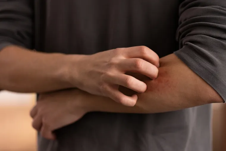 Vrućine utječu na ovu kožnu bolest: Dermatolozi objasnili za&scaron;to se simptomi pogor&scaron;avaju