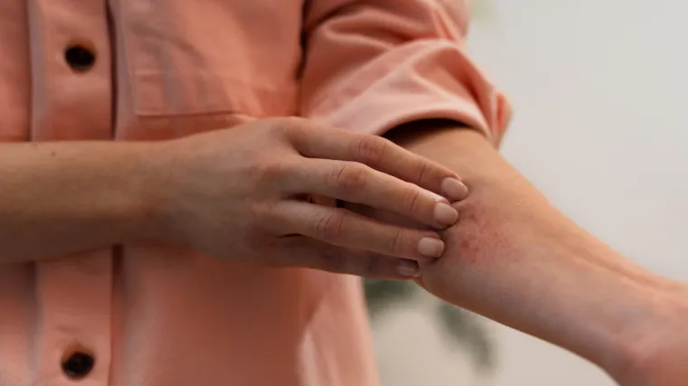 Vrućine utječu na ovu kožnu bolest: Dermatolozi objasnili za&scaron;to se simptomi pogor&scaron;avaju